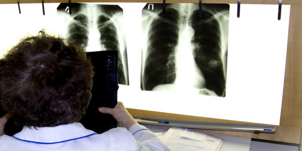 A Spanish study slows lung cancer relapses