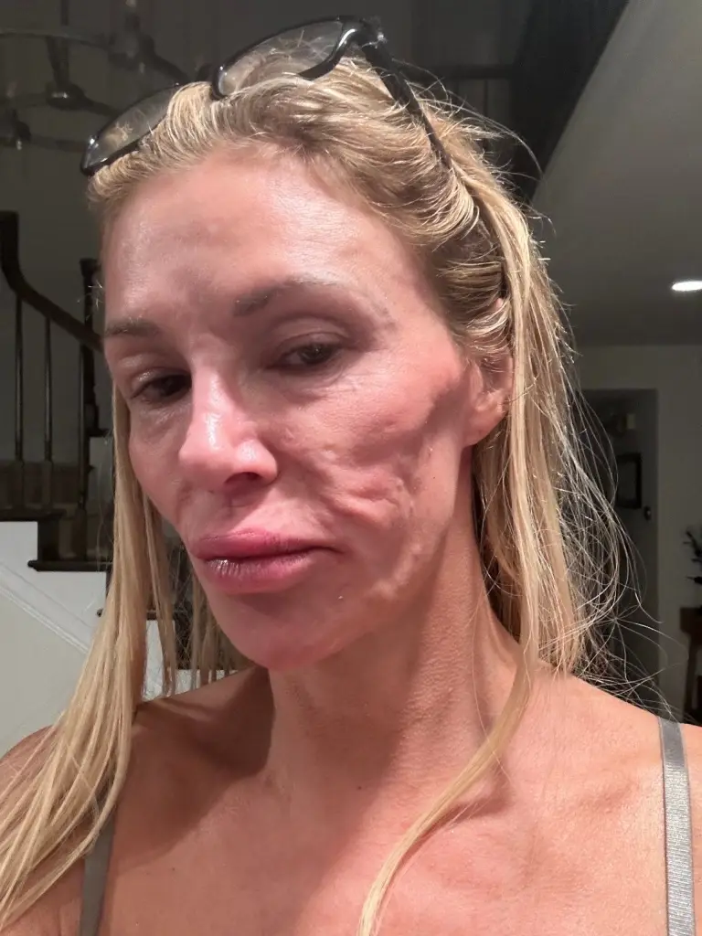 Brandi Glanville shows facial swelling in a selfie she shared on Instagram.